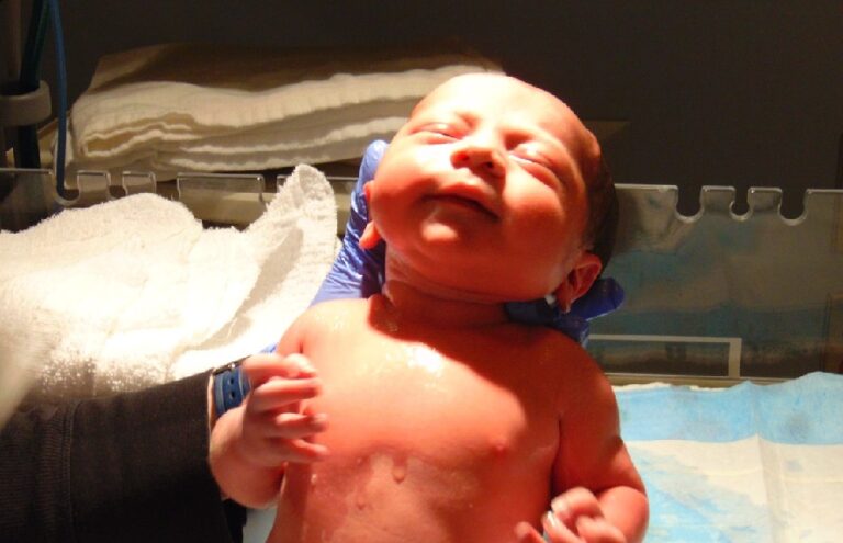 Tortícolis En Bebés