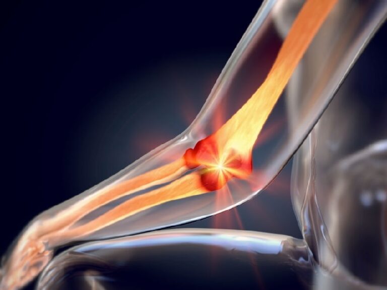 3d Illustration Of Lateral Epicondylitis, Or Tennis Elbow.