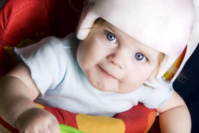 Como Tratar La Plagiocefalia