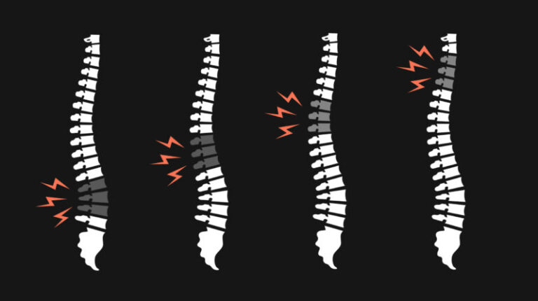 Vertebras